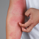 skin conditions